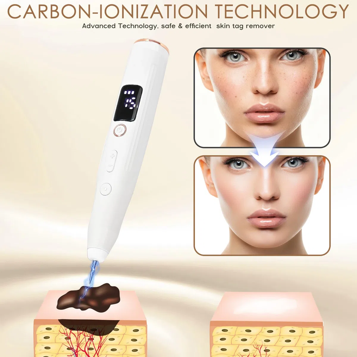 Sicura e Penna Al Plasma,Rimuove Voglie Verrucheskin Tag Remover con 15 Livelli Regolabili e Luce Led, Penna Al Plasma Ricaricabile Tramite Usb per Nei, Verruche, Lentiggini, Macchie Scure