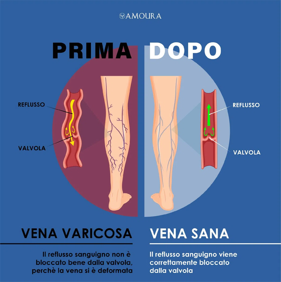 Amoura Crema Vene Varicose e Capillari - 100 ml - Crema Gambe Stanche e Pesanti - Made in Italy