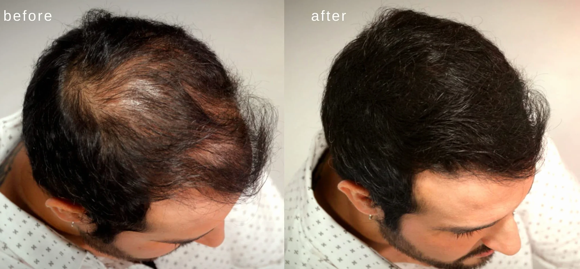 Volumizzante fibre dei capelli con vera cheratina per diradamento dei capelli/perdita di capelli - 60 giorni + fornitura - Risultati massimi istantaneamente - (Grigio)