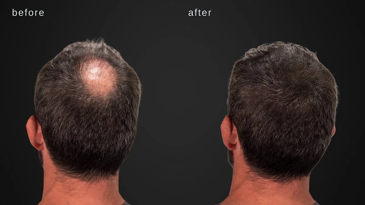 Volumizzante fibre dei capelli con vera cheratina per diradamento dei capelli/perdita di capelli - 60 giorni + fornitura - Risultati massimi istantaneamente - (Grigio)
