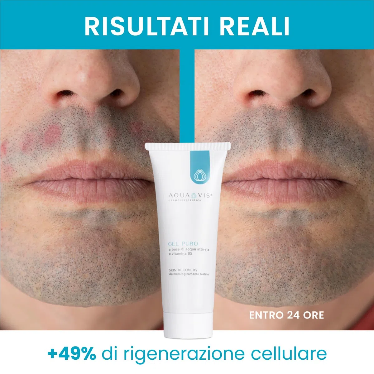 Aquavis - Aquavis Gel Puro Lenitivo per Pelle Acneica 75ml - 988153211